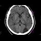 Ischemic focus in brain: CT - Computed tomography